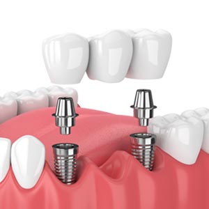 best implant dentist in chicago