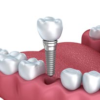dental implants chicago