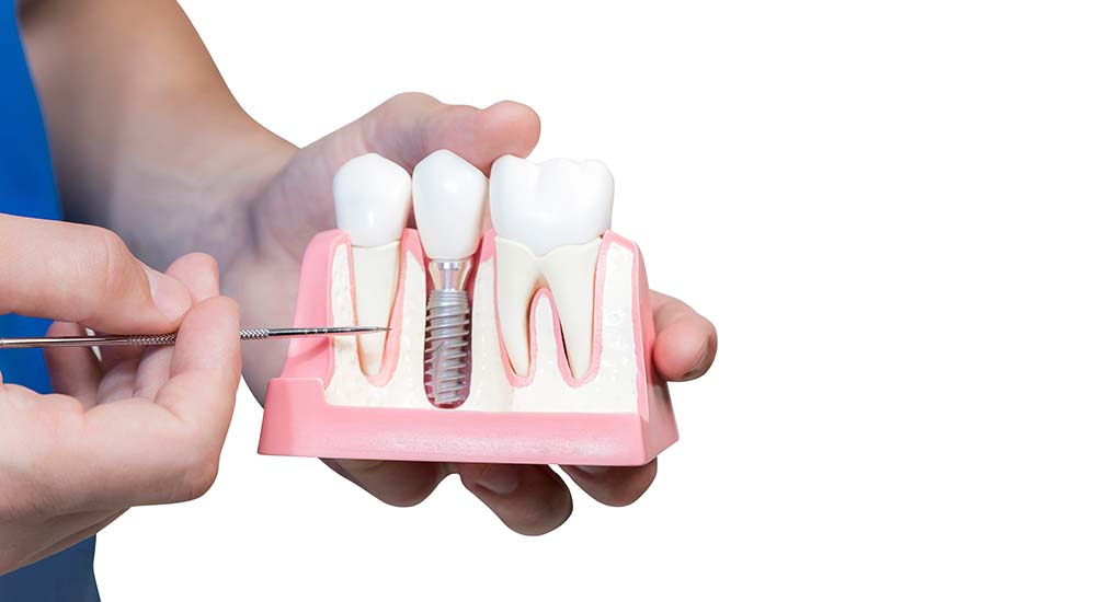 Everything You Need to Know Before Having a Dental Bone Graft