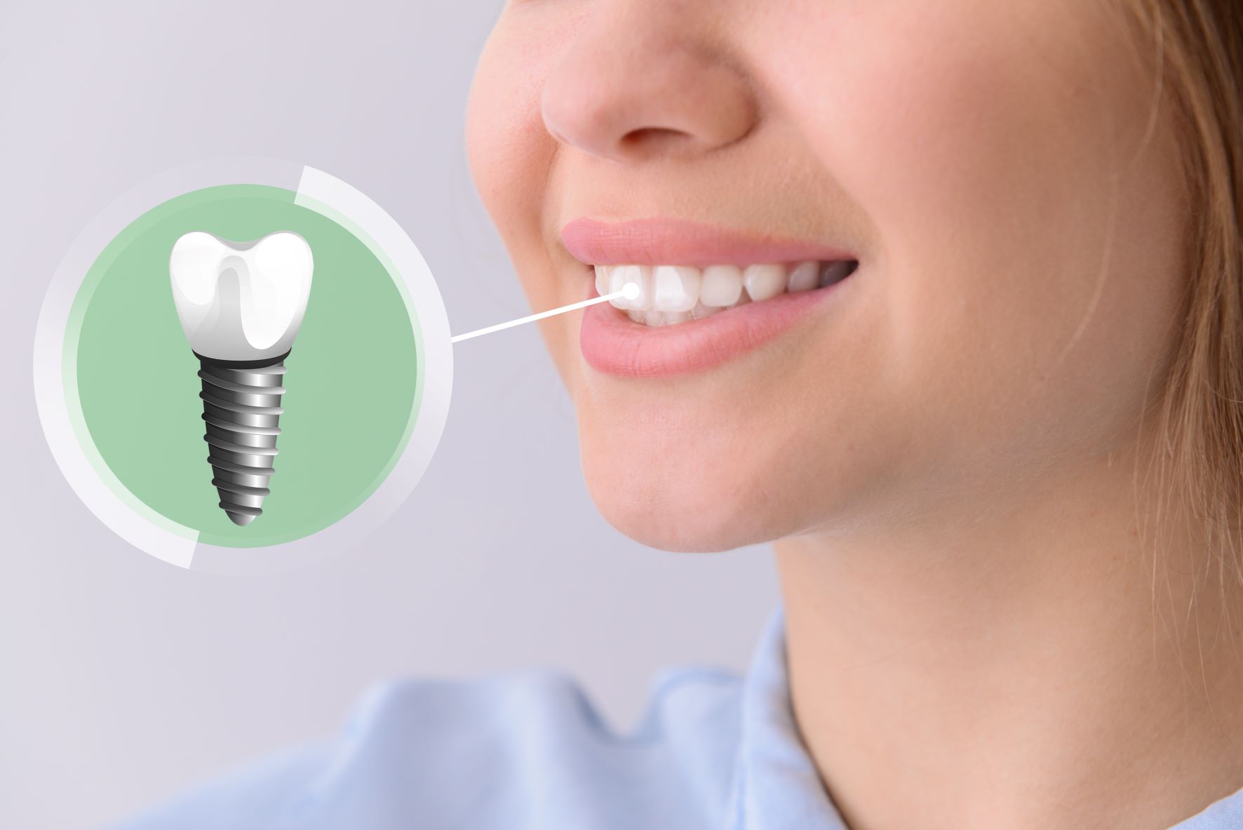 How Long Does It Take To Recover From Dental Implant Surgery 