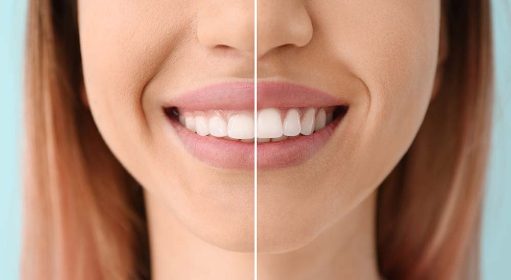 What Is Gum Contouring? When to Have It Done American Dental