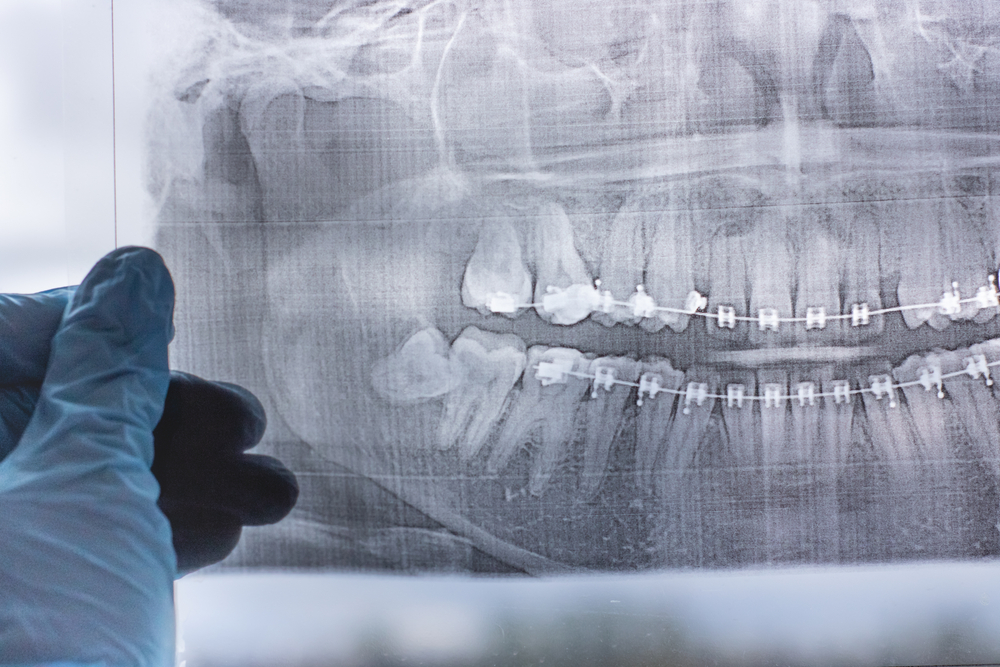 Is General Anesthesia Necessary for Wisdom Teeth Removal? - American Dental